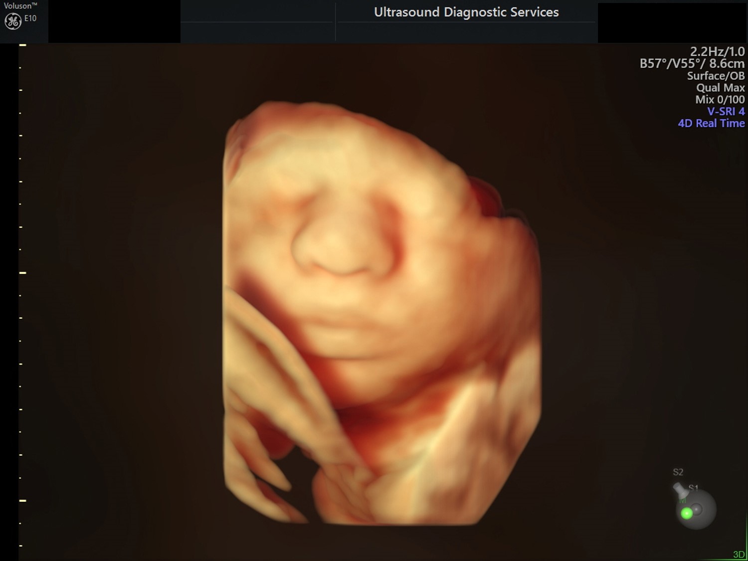 3D scan of fetus